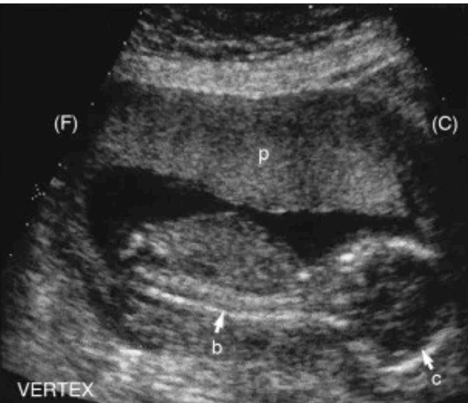 Obstetric OB Ultrasound Made Easy Step By Step Guide POCUS 101