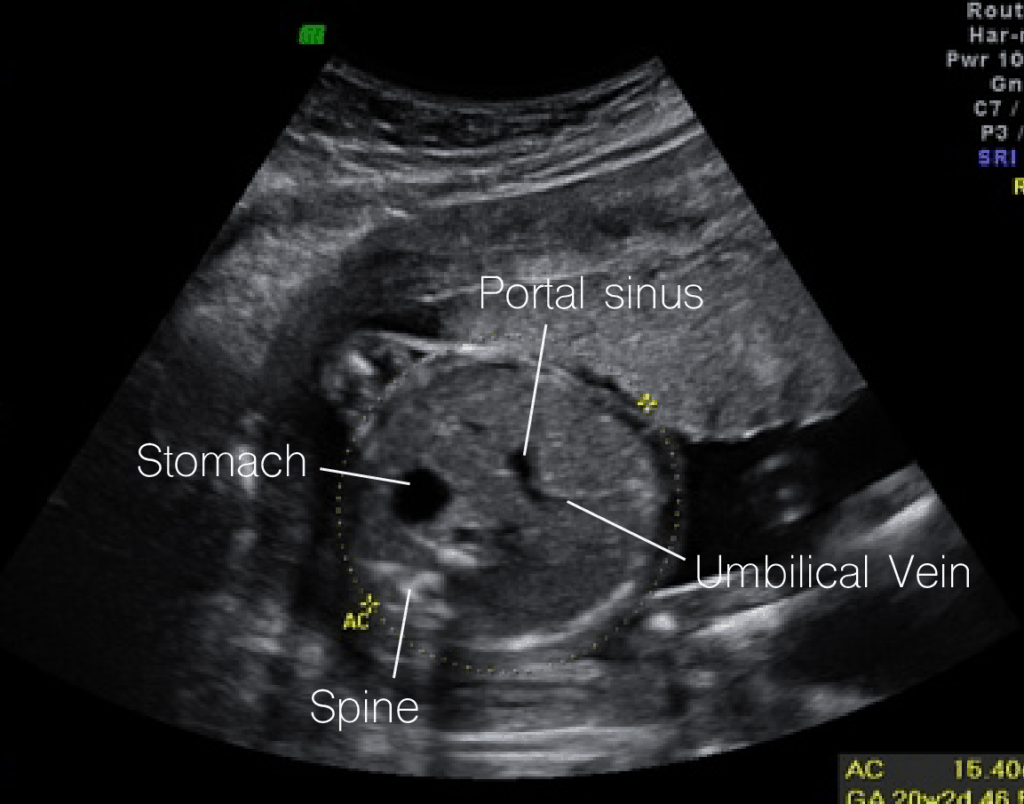 Obstetric OB Ultrasound Made Easy Step By Step Guide POCUS 101